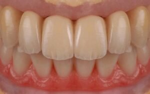 Implantes-dentales